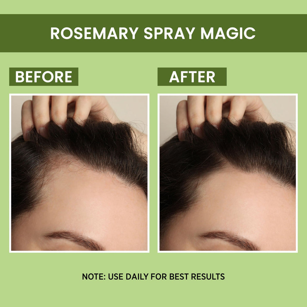 Rosemary Water ( BUY 1 GET 1 FREE ) | Hair Spray For Regrowth